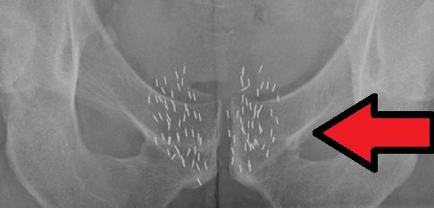 Brachytherapy seeds