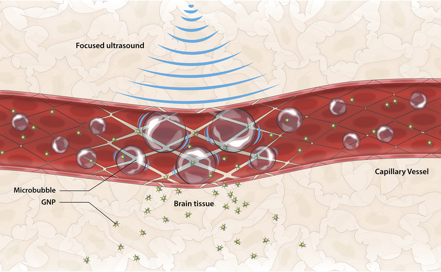 MR-guided Focused Ultrasound to intensify GBM treatment